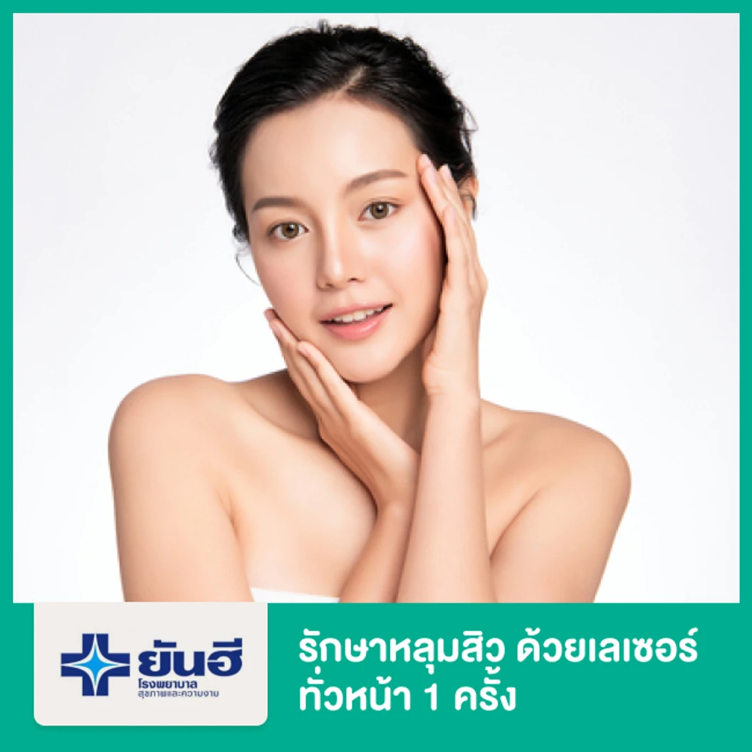 รักษาหลุมสิว ด้วยเลเซอร์ Sublative Rejuvention เครื่อง Ematrix Subeative ทั่วหน้า 1 ครั้ง