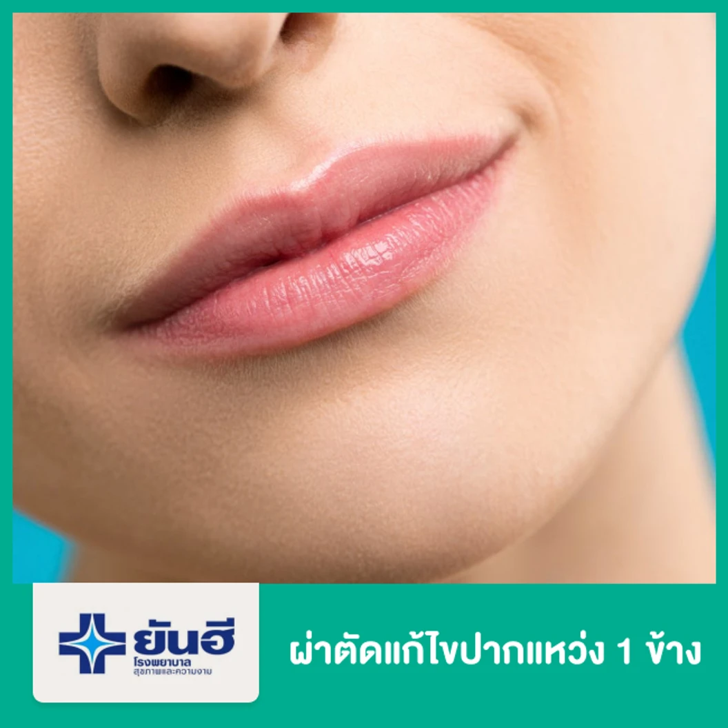 ผ่าตัดแก้ไขปากแหว่ง 1 ข้าง