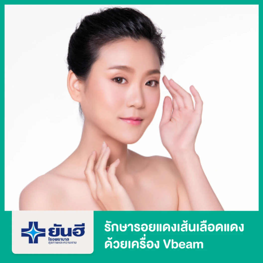 รักษารอยแดงเส้นเลือดแดง ด้วยเครื่อง Vbeam