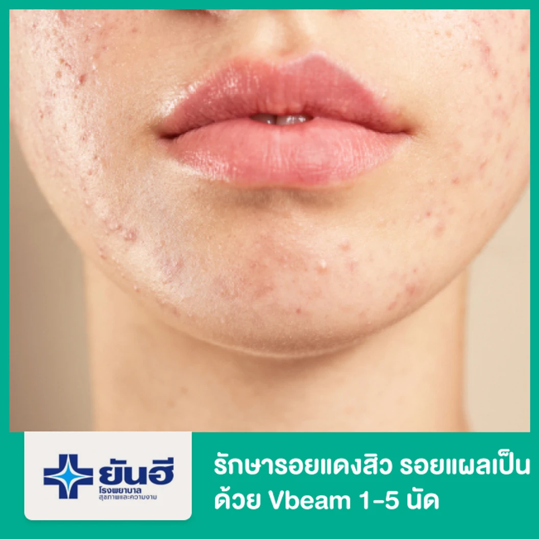 รักษารอยแดงจากสิว รอยแผลเป็น ด้วยเครื่อง Vbeam 1-5 ช็อตแรก
