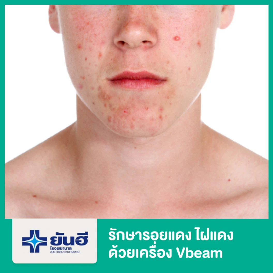 รักษารอยแดงไฝแดง ด้วยเครื่อง Vbeam 1 จุดแรก