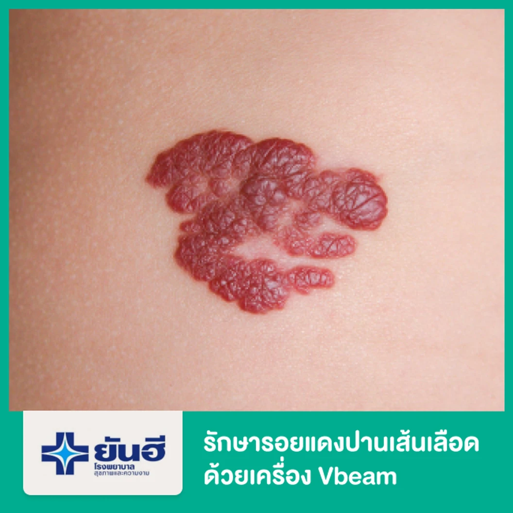 รักษารอยแดงปานเส้นเลือด ด้วยเครื่อง Vbeam
