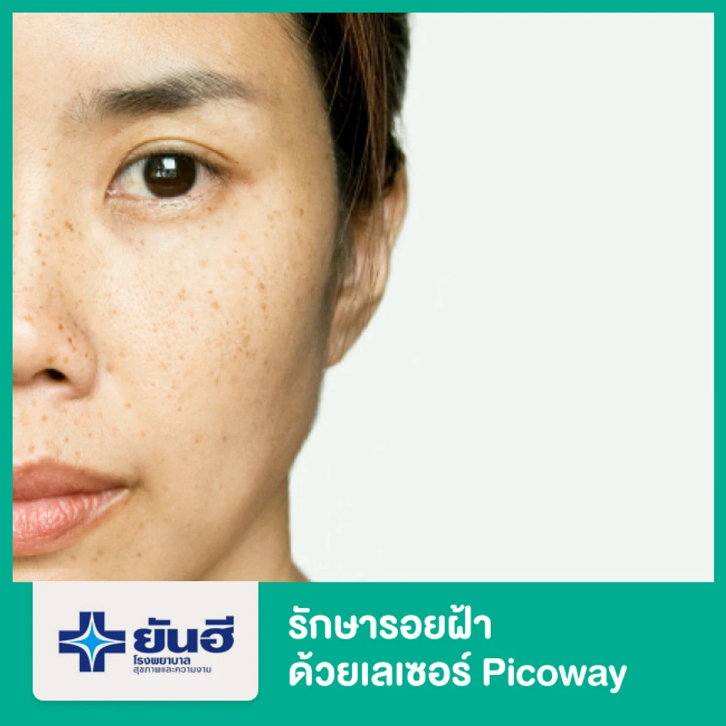 รักษารอยฝ้า ด้วยเลเซอร์ Picoway