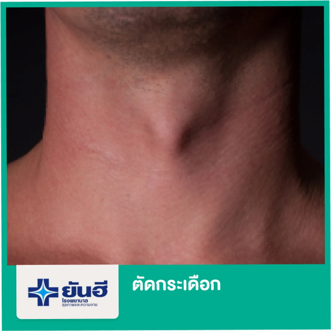 ตัดกระเดือก