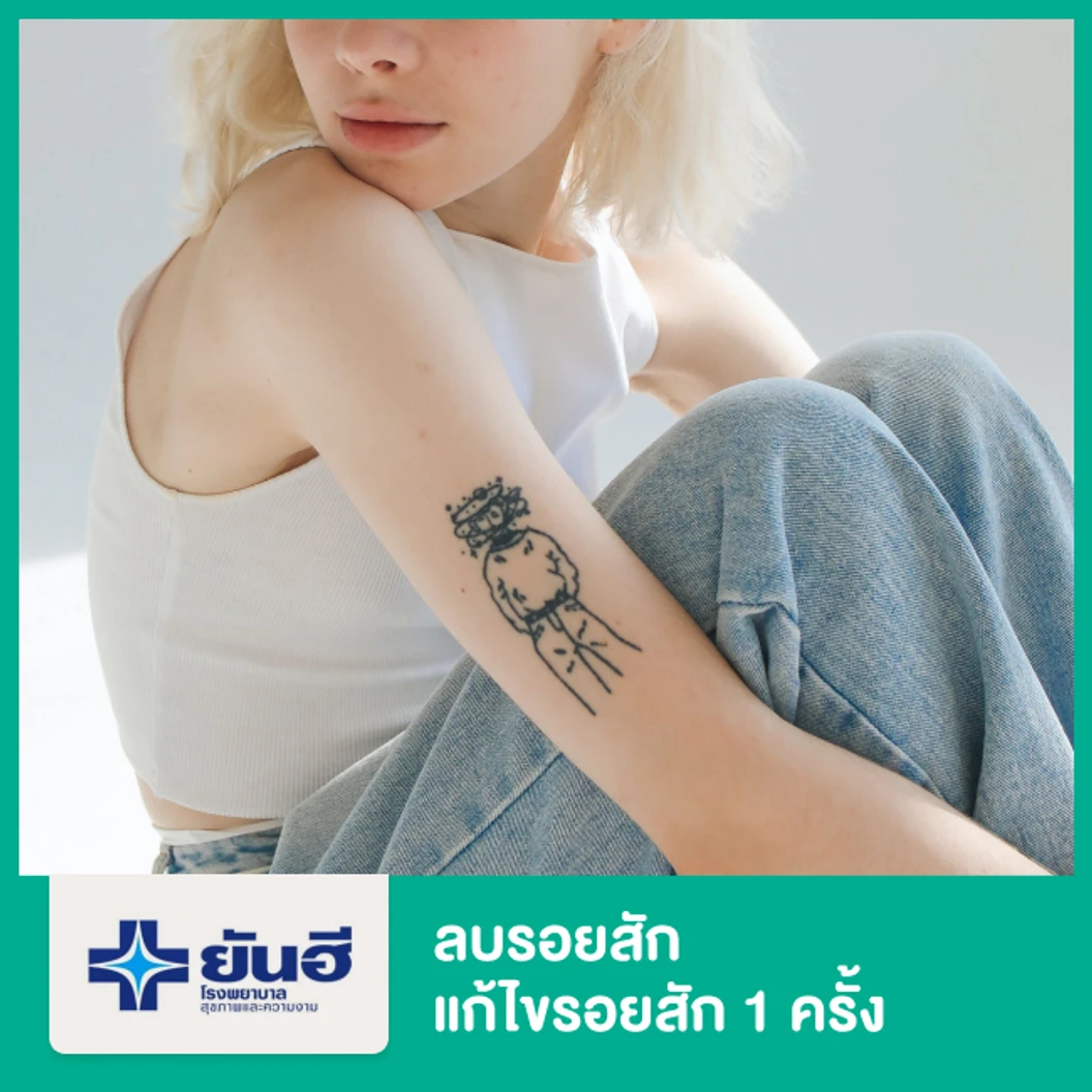 ลบรอยสัก แก้ไขรอยสัก 1 ตร. ซม. 1 ครั้ง