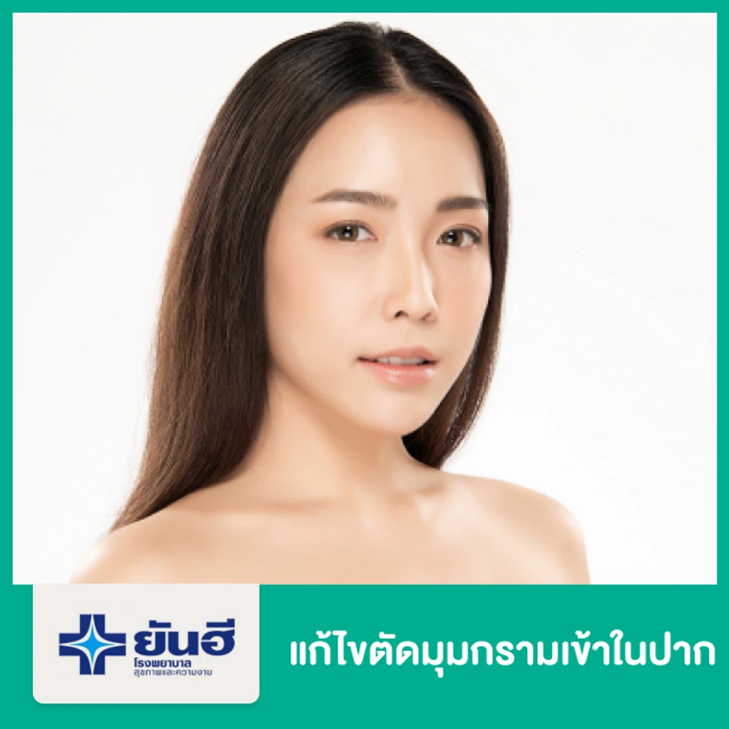 แก้ไขตัดกราม เทคนิคแผลในช่องปาก พักฟื้นรพ. 2 คืน