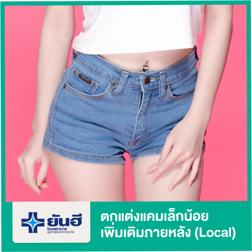 ตกแต่งแคมเล็กน้อยเพิ่มเติมภายหลังการแปลงเพศ (Local)