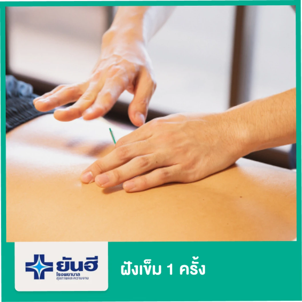 ฝังเข็ม 1 ครั้ง