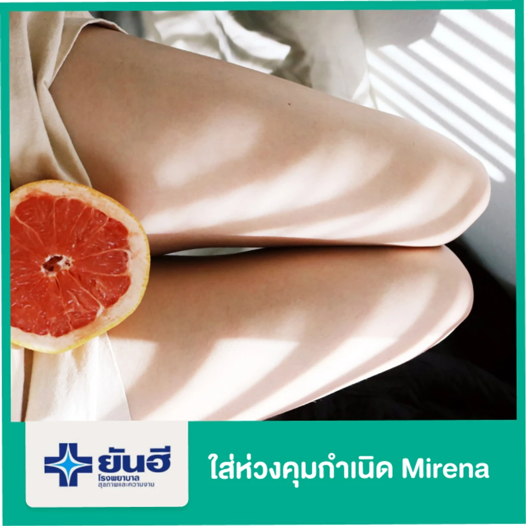 ใส่ห่วงคุมกำเนิด Mirena