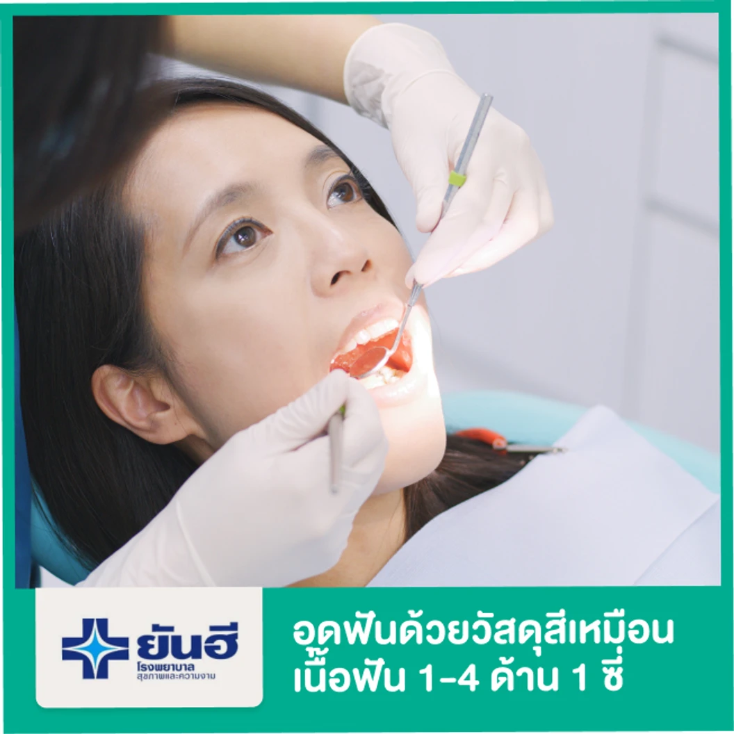 อุดฟัน ด้วยวัสดุสีเหมือนฟัน 1-4 ด้าน 1 ซี่