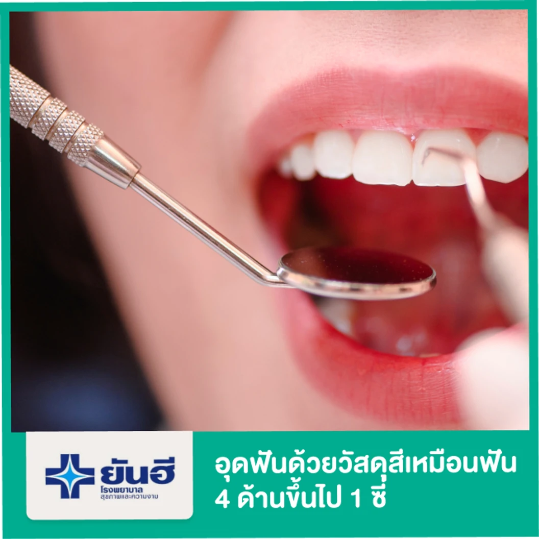 อุดฟัน ด้วยวัสดุสีเหมือนฟัน 4 ด้านขึ้นไป 1 ซี่