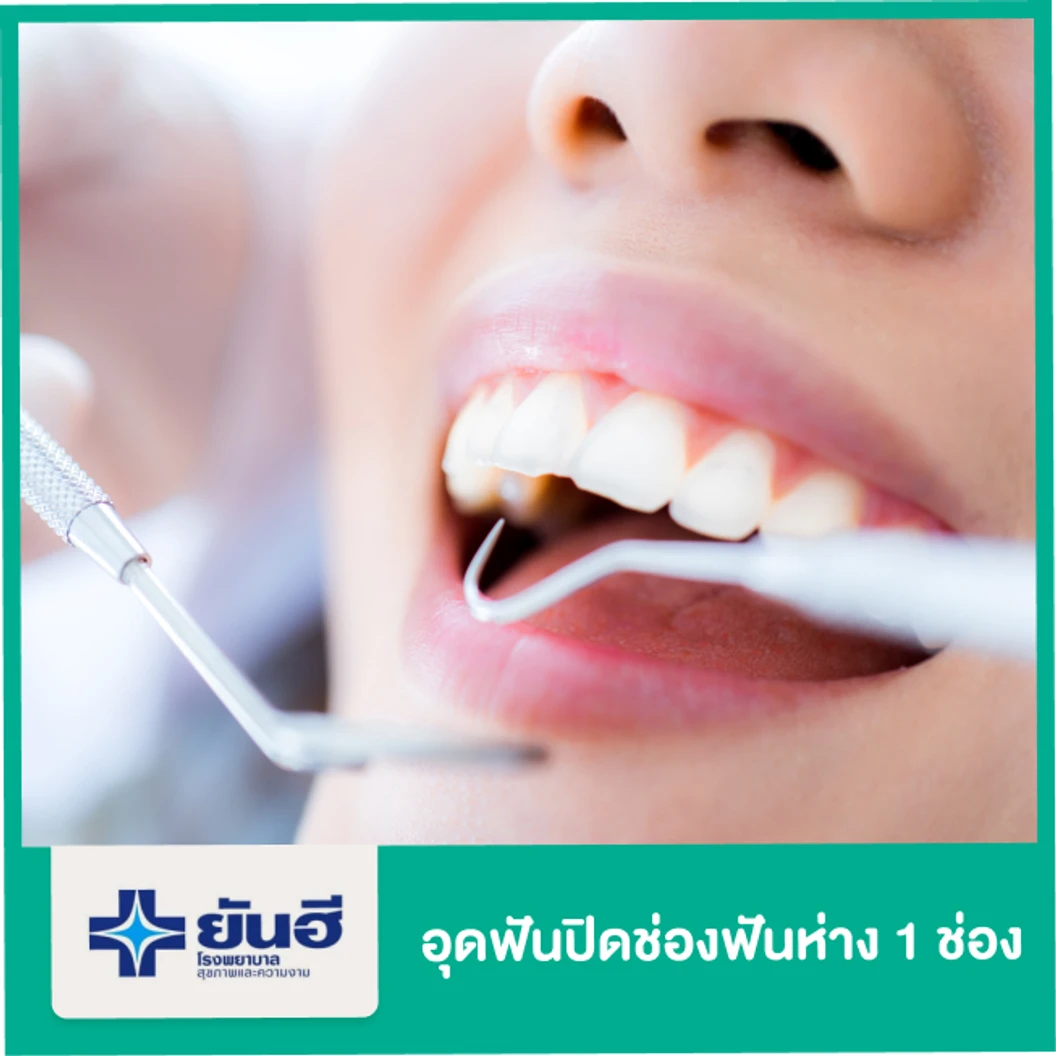 อุดฟันปิดช่องฟันห่าง 1 ช่อง