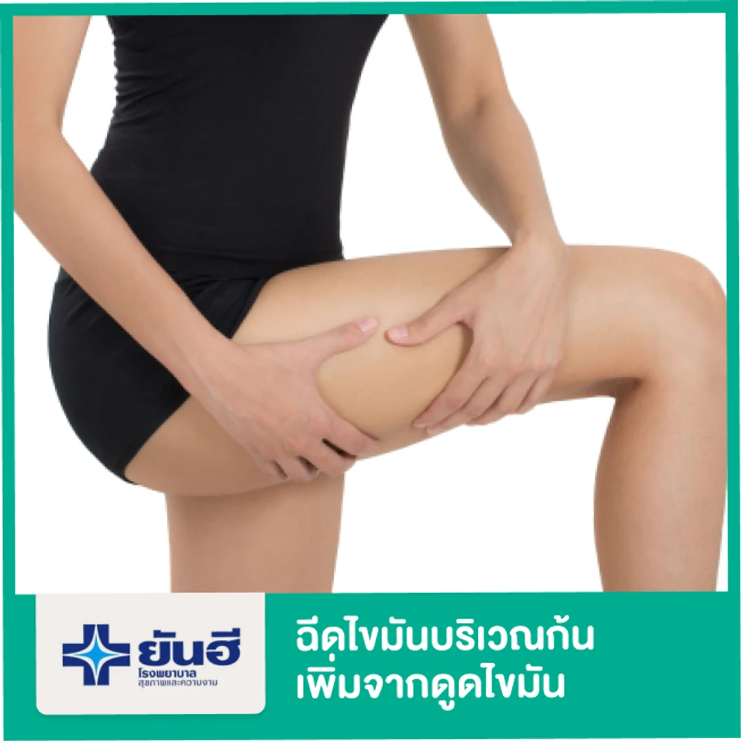 เติมไขมันบริเวณก้น (Lipofilling Buttock) เพิ่มจากดูดไขมัน