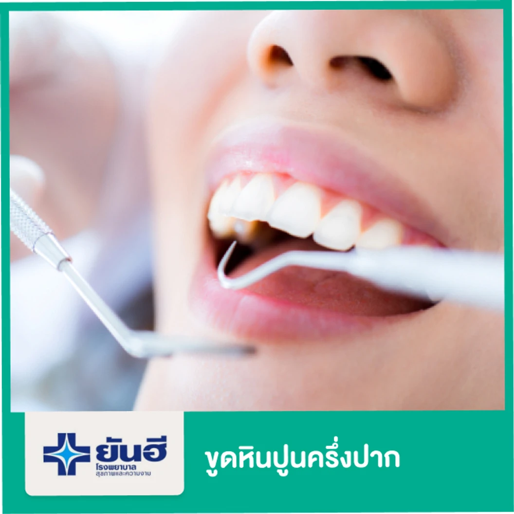 ขูดหินปูนครึ่งปาก