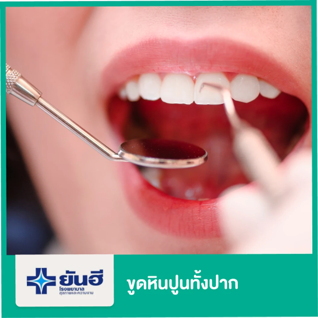 ขูดหินปูนทั้งปาก