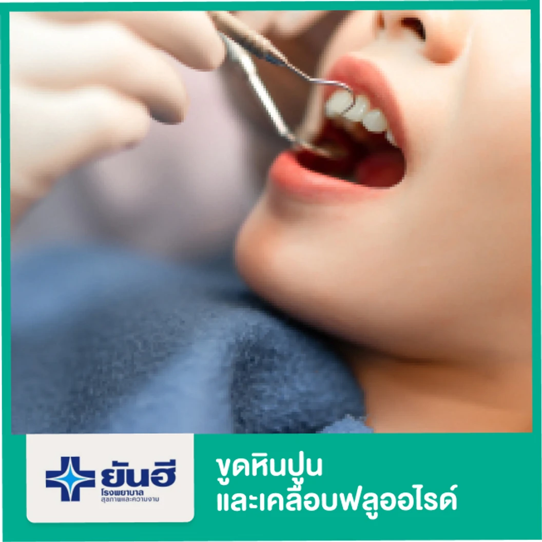ขูดหินปูนและเคลือบฟลูออไรด์