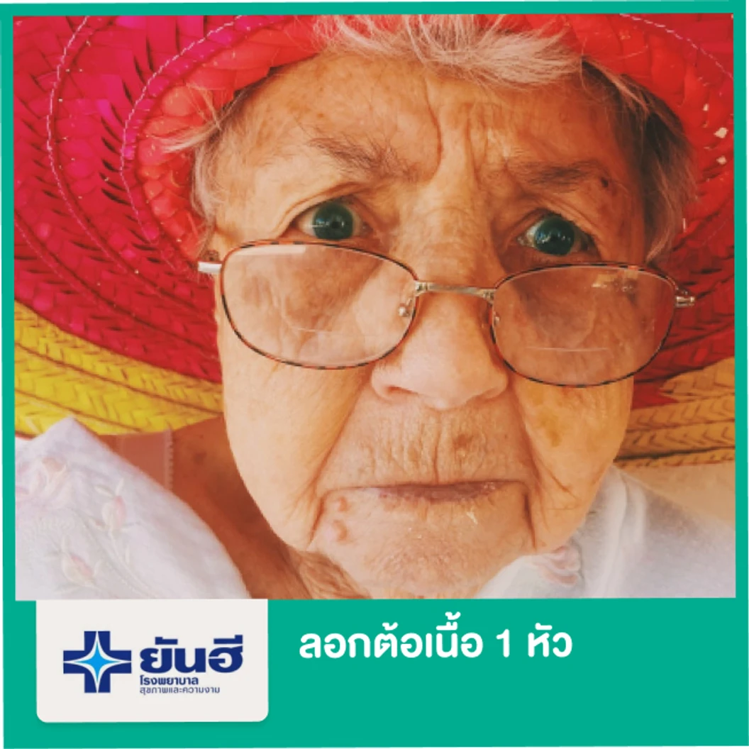 ลอกต้อเนื้อ 1 หัว