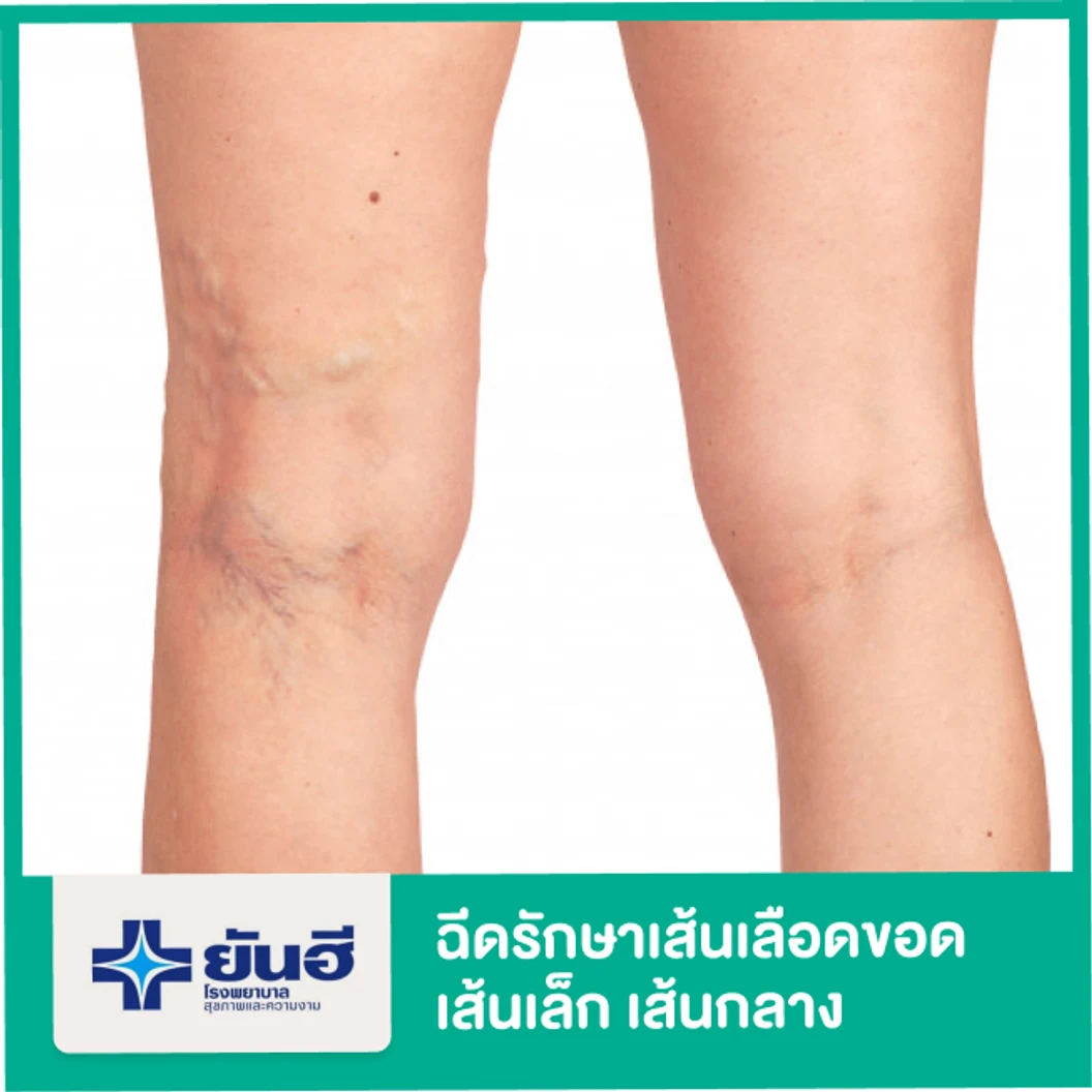 ฉีดรักษาเส้นเลือดขอด เส้นเล็ก เส้นกลาง