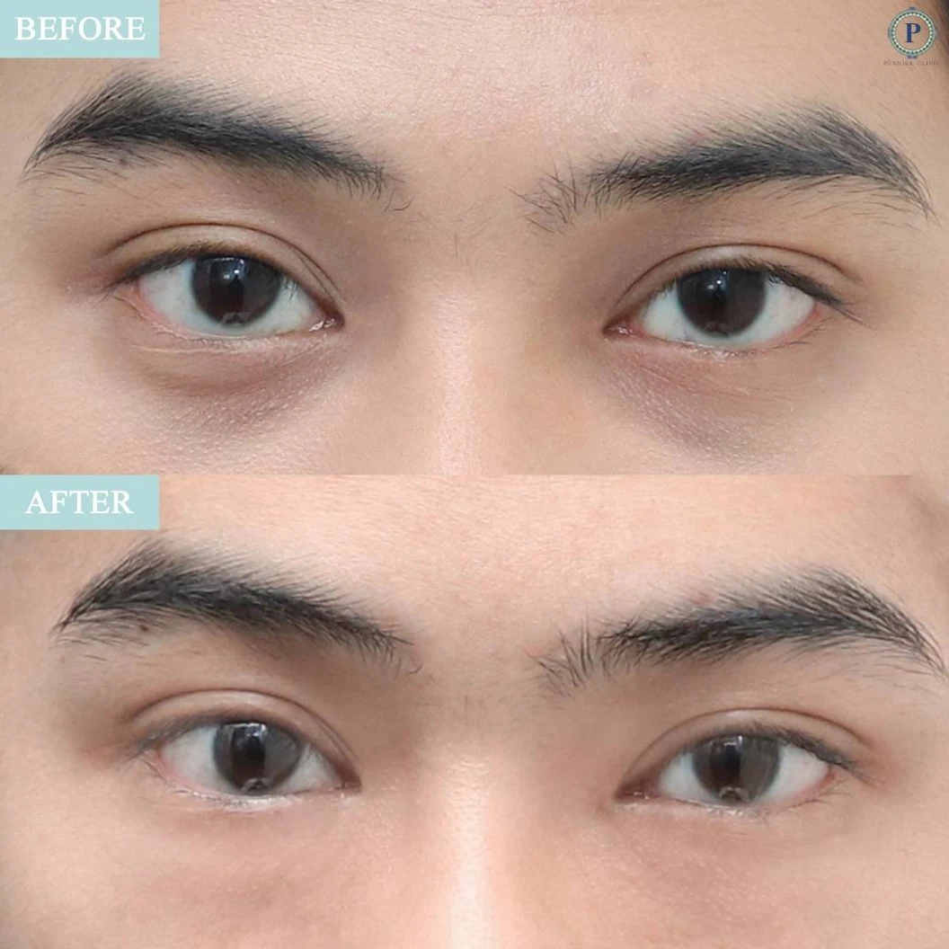 โปรแกรมเมโส Angle Drop HA แก้รอยคล้ำและปรับสภาพผิวใต้ตา 1 ครั้ง