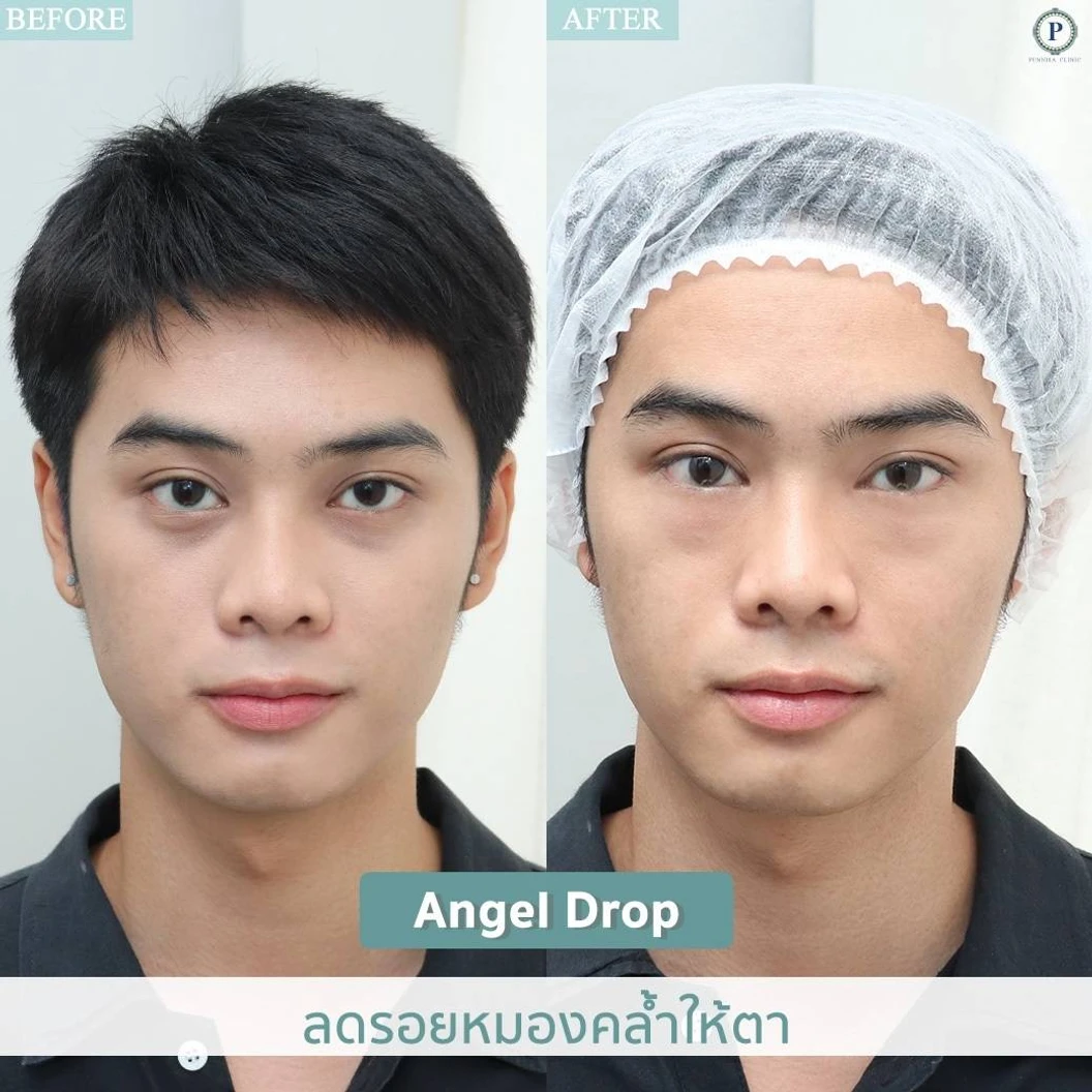 โปรแกรมเมโส Angle Drop HA แก้รอยคล้ำและปรับสภาพผิวใต้ตา 1 ครั้ง