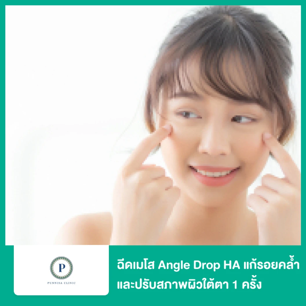 โปรแกรมเมโส Angle Drop HA แก้รอยคล้ำและปรับสภาพผิวใต้ตา 1 ครั้ง