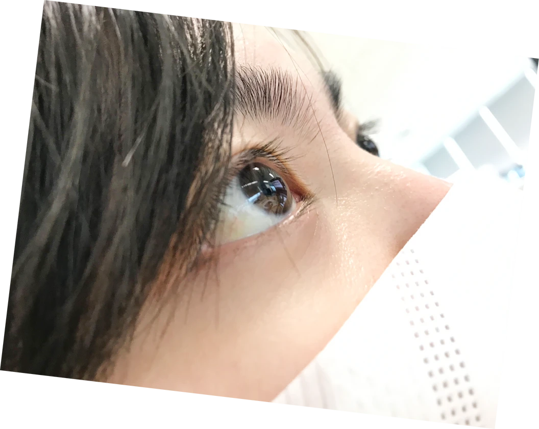 ผ่าตัดปรับค่าสายตา ด้วยเทคนิค SBK LASIK สำหรับตา 2 ข้าง
