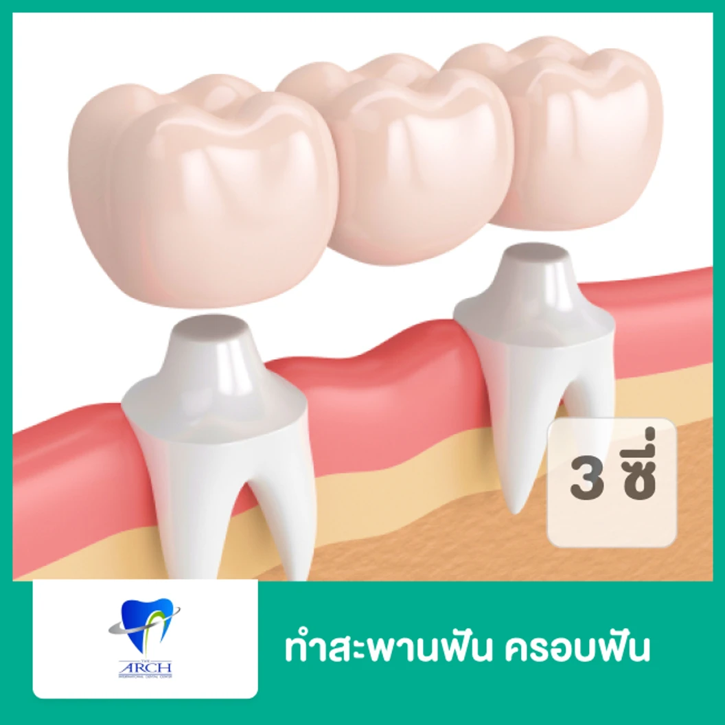 ทำสะพานฟัน (ครอบฟัน 3 ซี่)