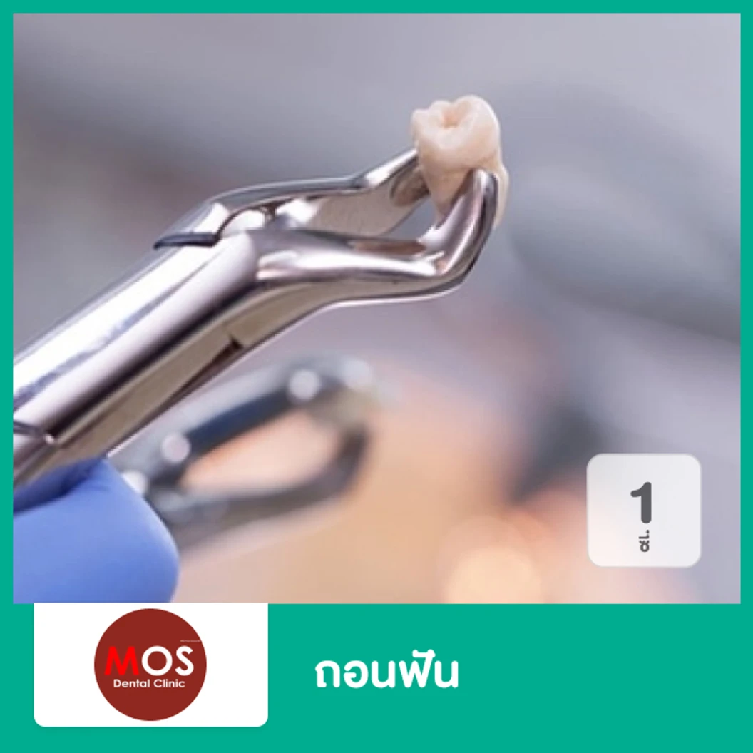 ถอนฟัน 1 ซี่