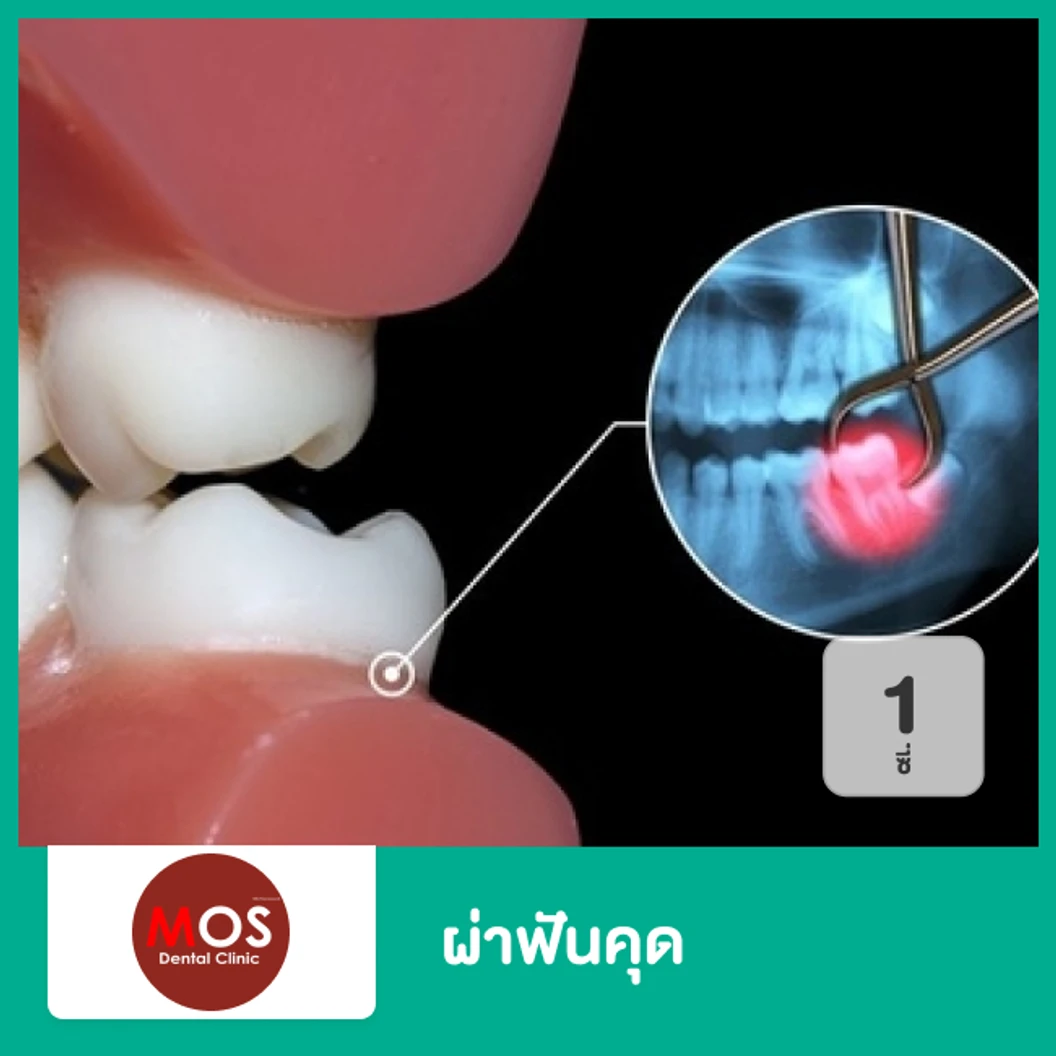 ผ่าฟันคุด ทุกประเภท 1 ซี่