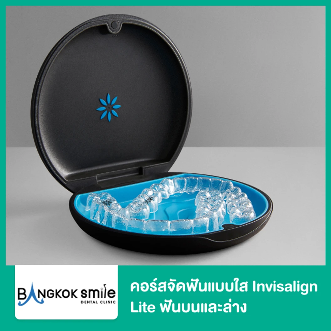 คอร์สจัดฟันแบบใส Invisalign Lite ฟันบนและล่าง เครื่องมือ 14 ชิ้น