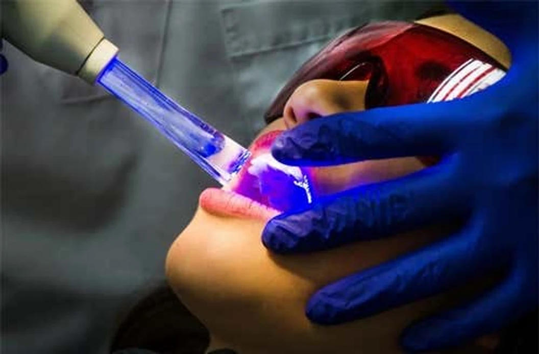 ฟอกสีฟัน ด้วยระบบ Cool light