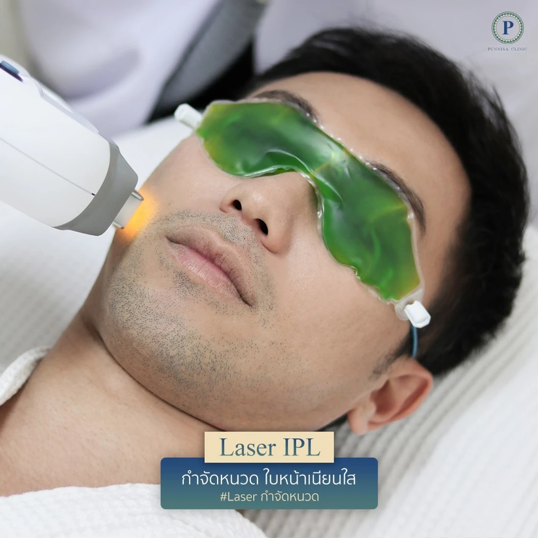 กำจัดขนหนวดด้วย IPL 1 ครั้ง