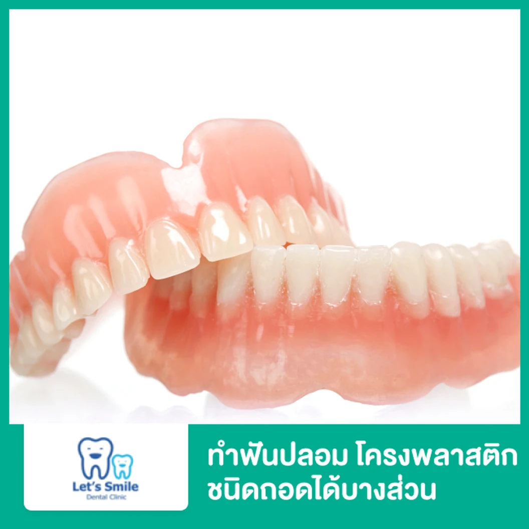 ทำฟันปลอมโครงพลาสติก ชนิดถอดได้บางส่วน 1 ชิ้น รวมฟัน 1 ซี่ สำหรับฟันบนหรือล่าง