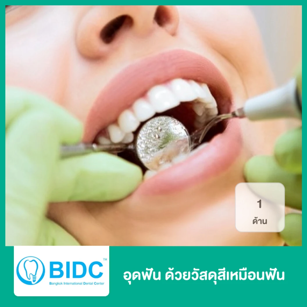 อุดฟัน 1 ด้าน ด้วยวัสดุสีเหมือนฟัน