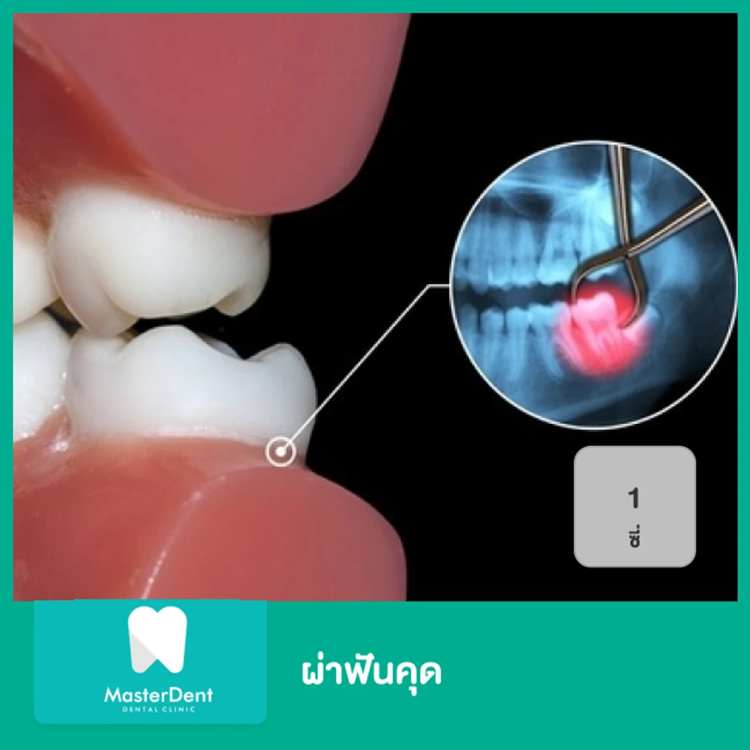 ผ่าฟันคุด 1 ซี่