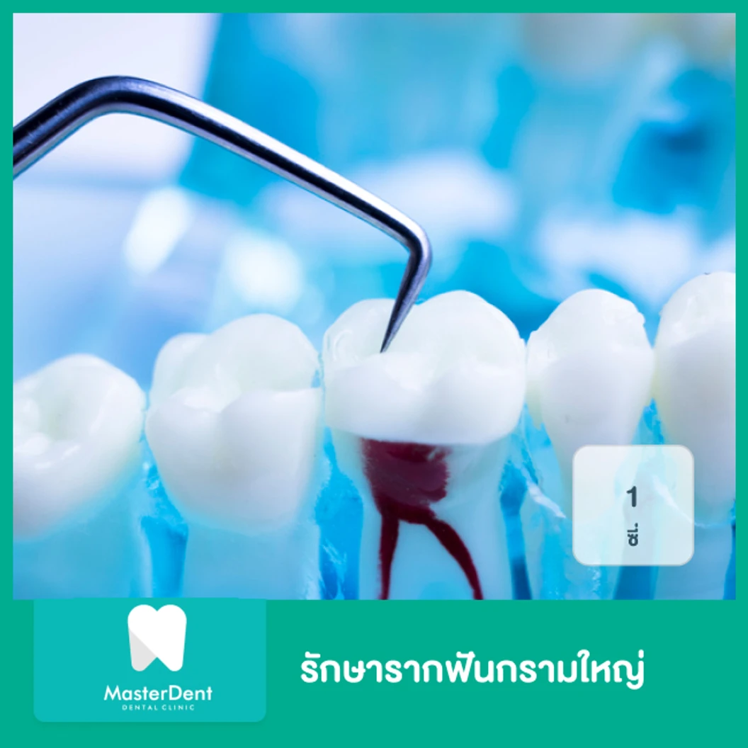 รักษารากฟันกรามใหญ่ 1 ซี่