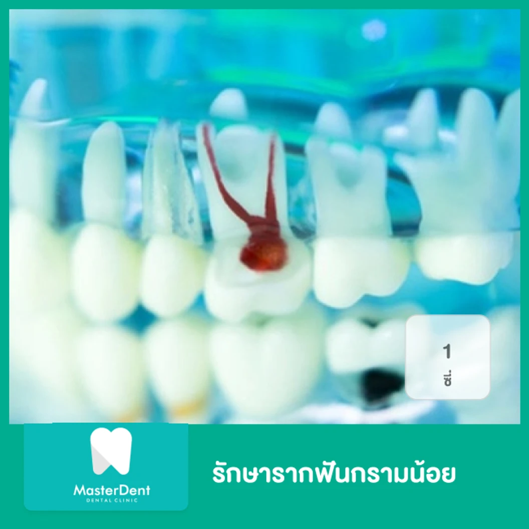 รักษารากฟันกรามน้อย 1 ซี่