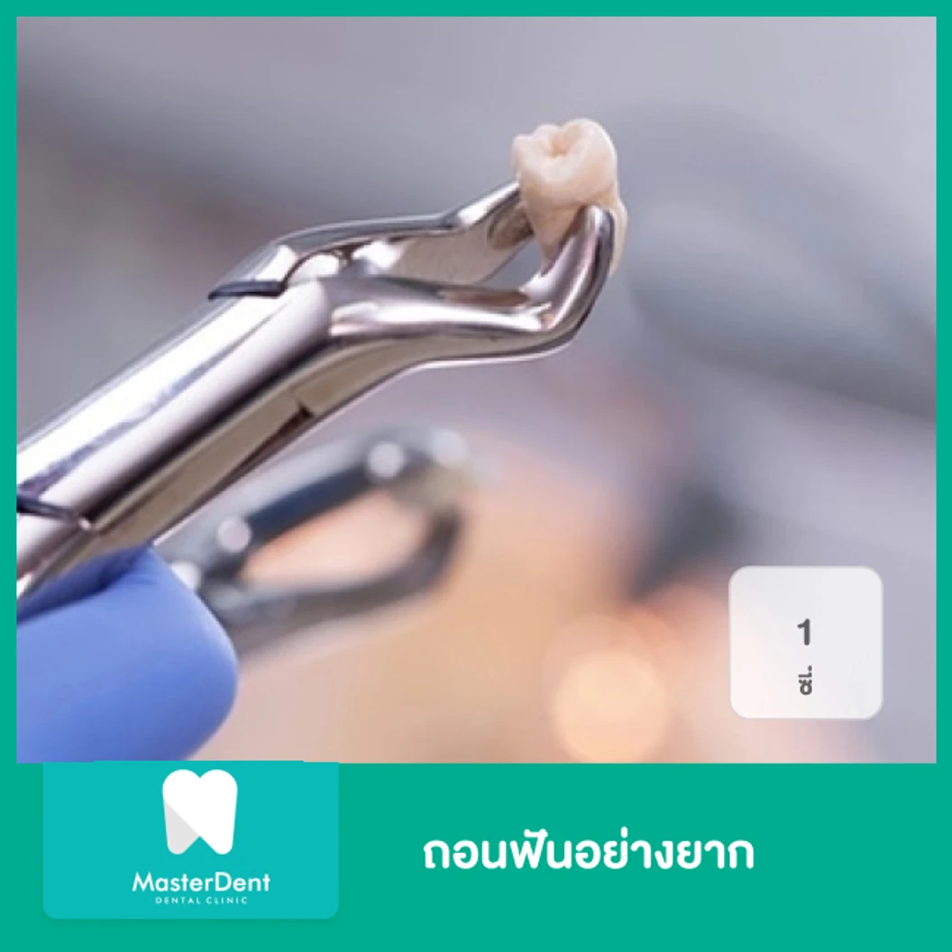 ถอนฟันอย่างยาก 1 ซี่