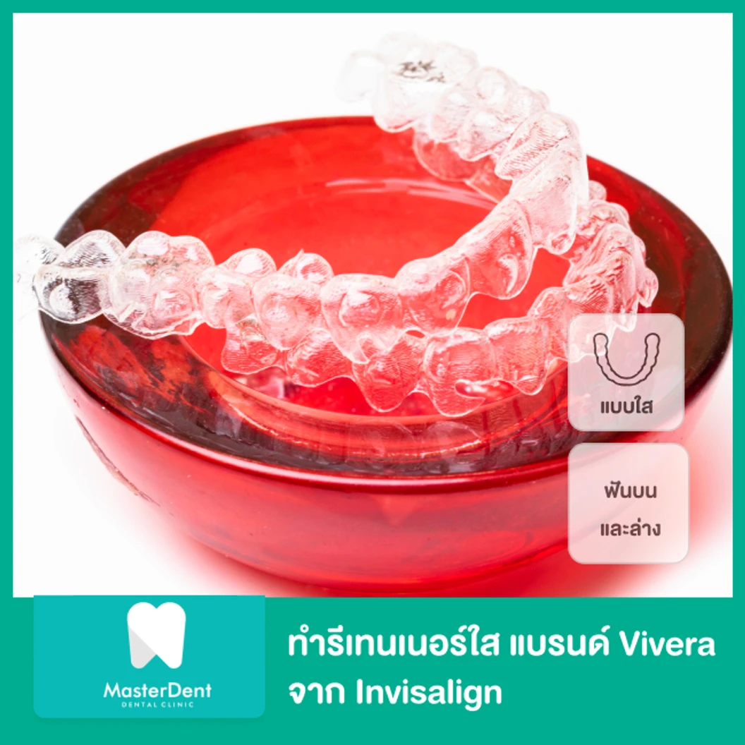ทำรีเทนเนอร์ใส แบรนด์ Vivera จาก Invisalign ฟันบนและล่าง