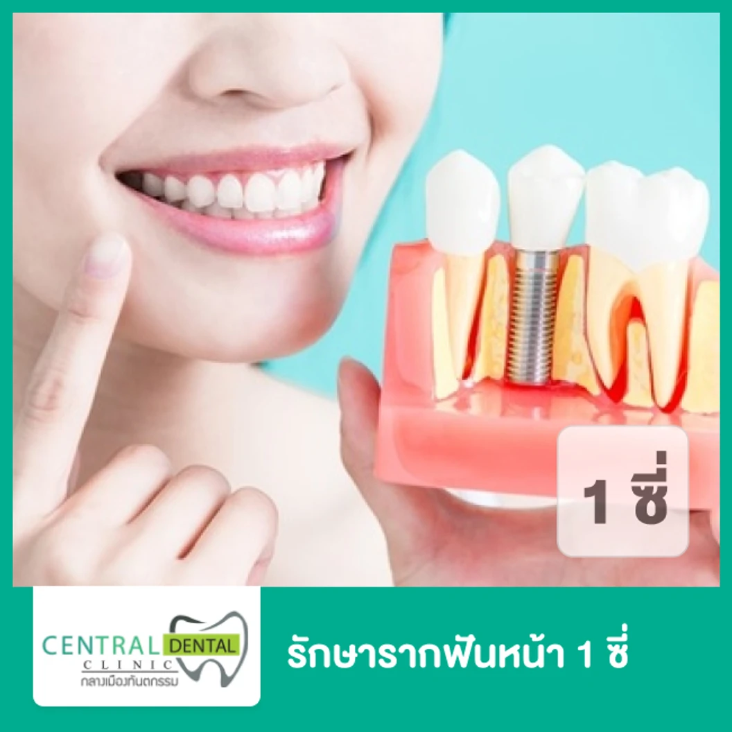 รักษารากฟันหน้า 1 ซี่