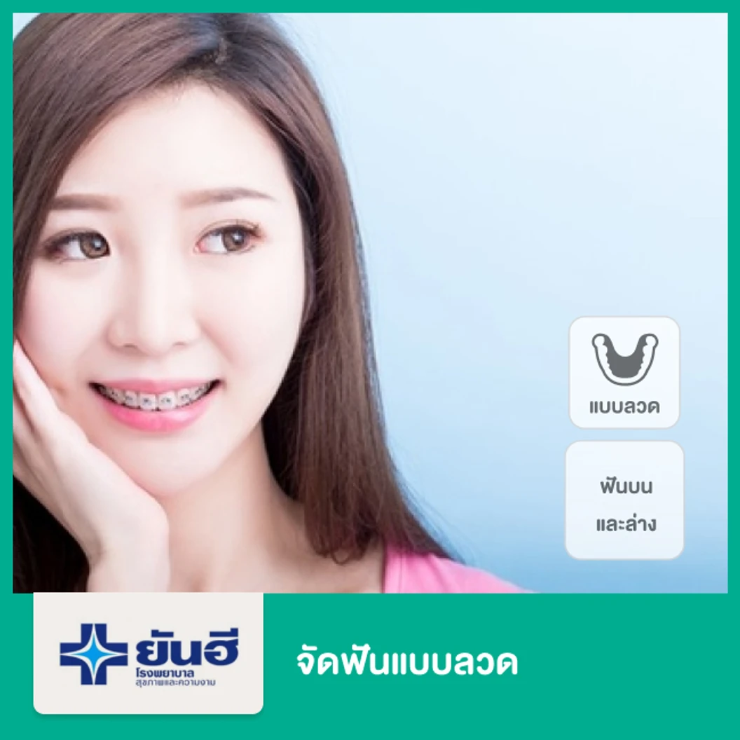 จัดฟันลวด ฟันบนและล่าง