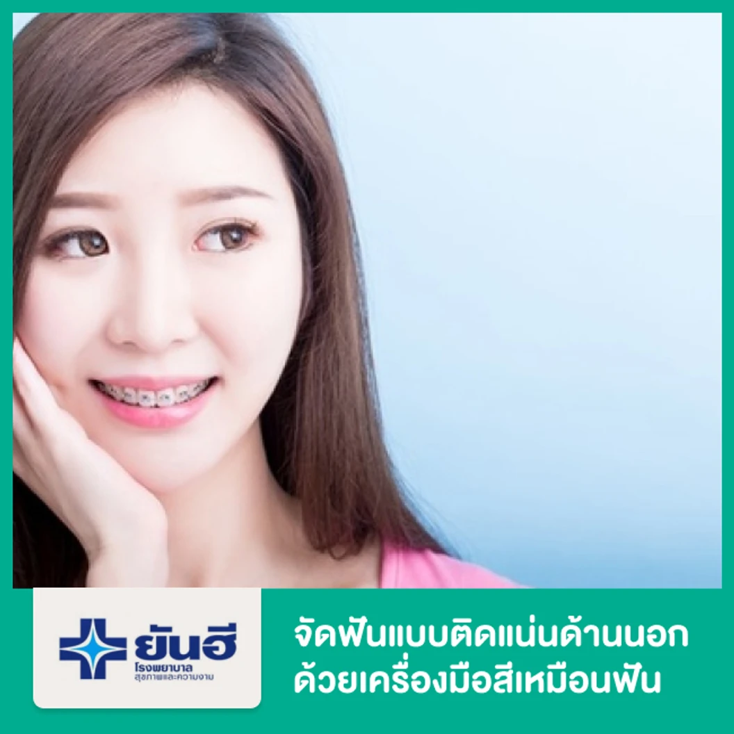 จัดฟันแบบติดแน่นด้านนอก ด้วยเครื่องมือสีเหมือนฟัน