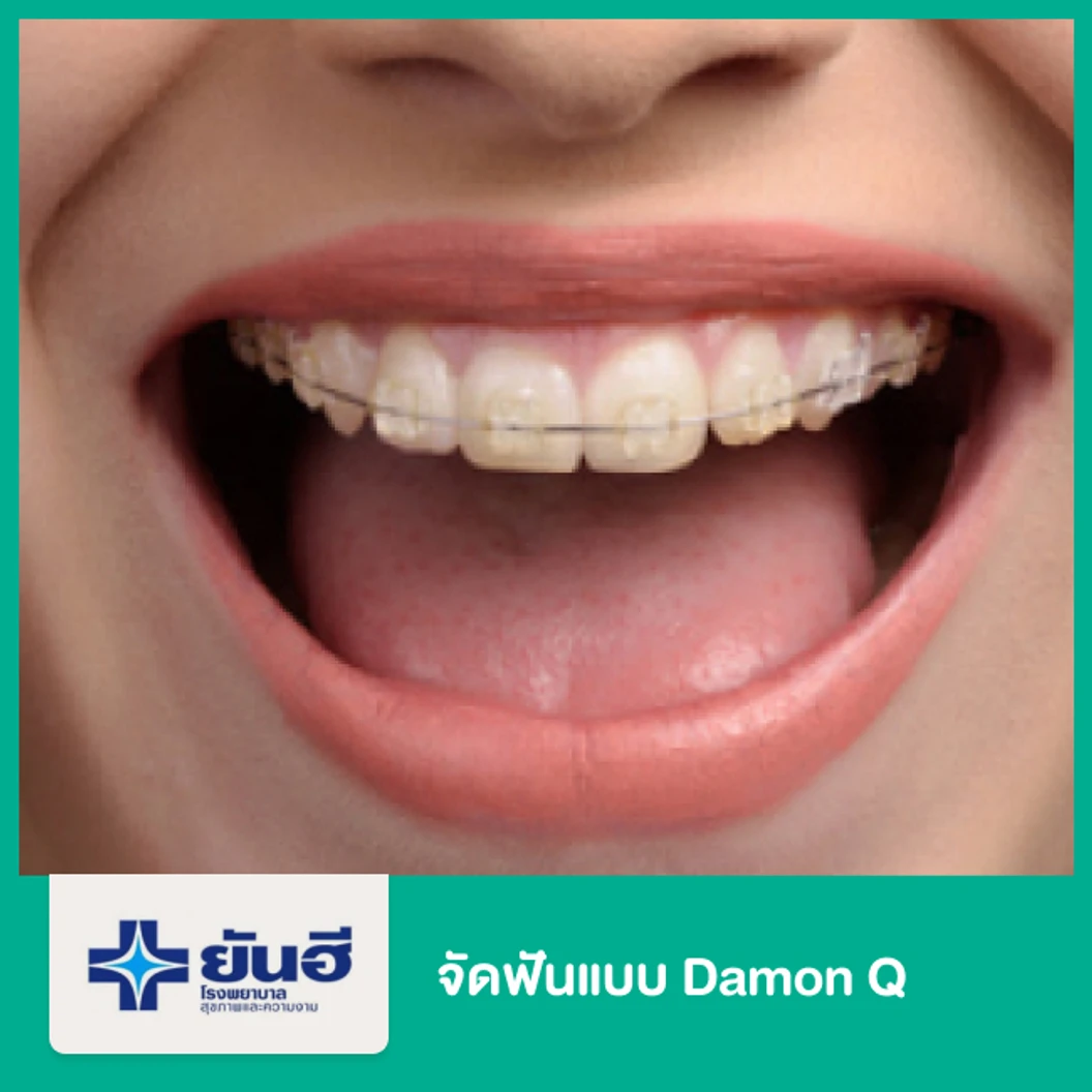จัดฟันแบบ Damon Q