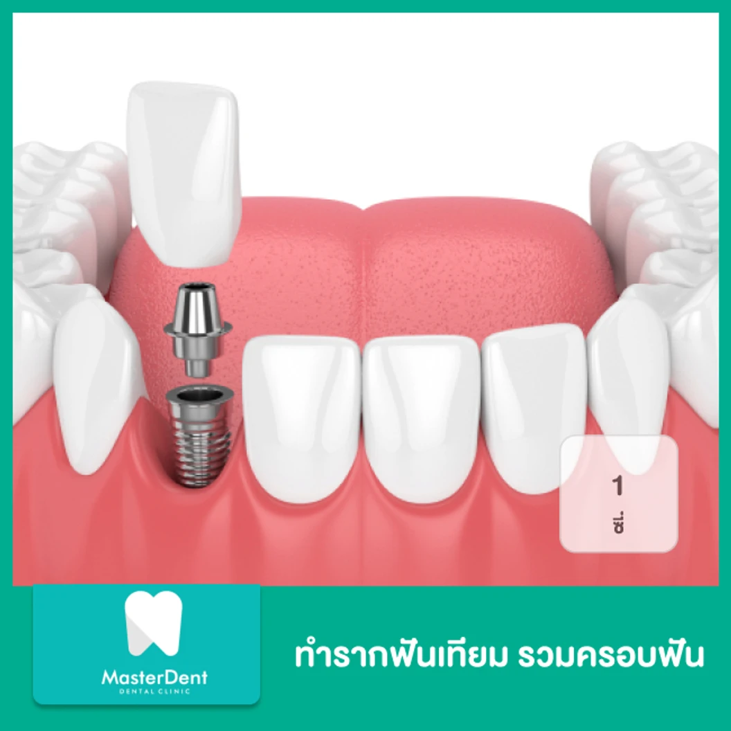 ทำรากฟันเทียม รวมครอบฟัน 1 ซี่
