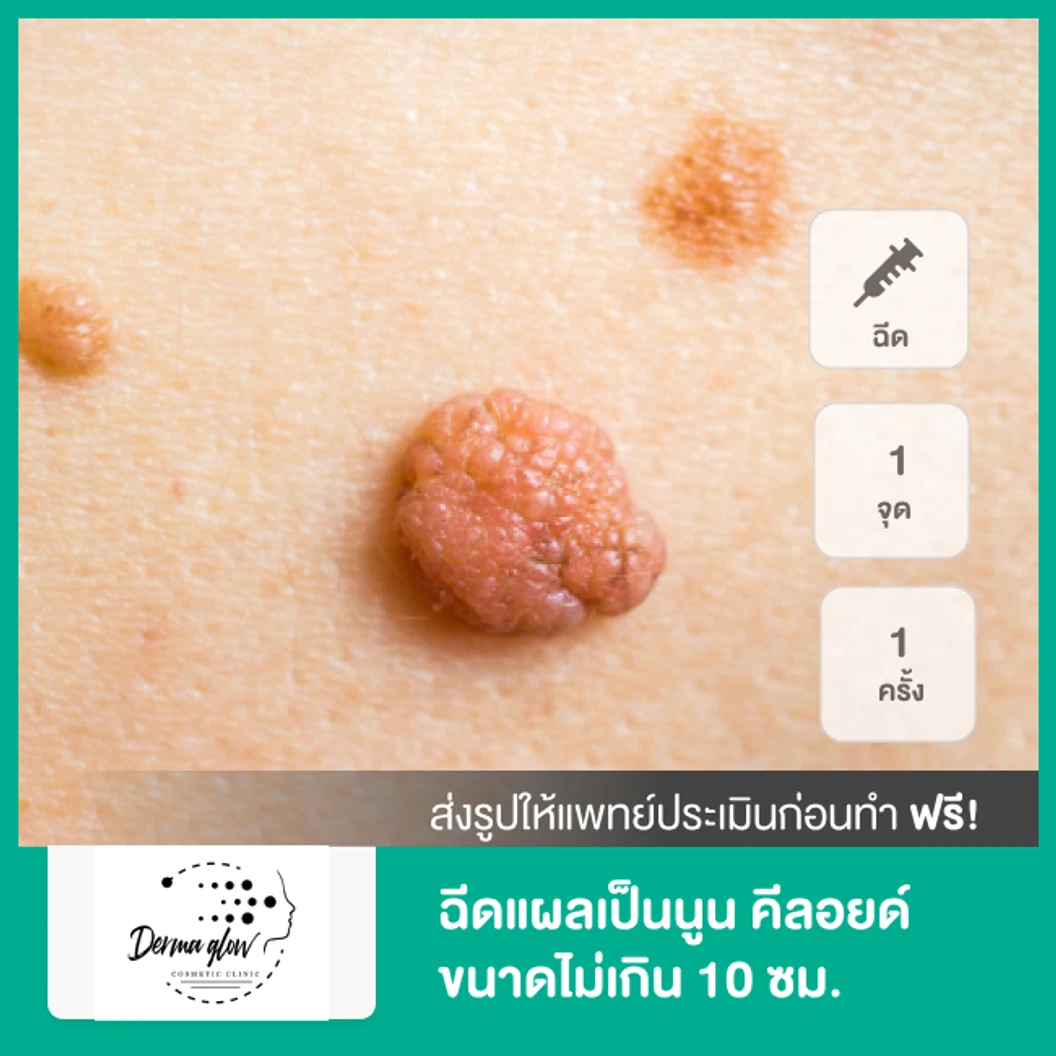 ฉีดแผลเป็นนูน คีลอยด์ ขนาดไม่เกิน 10 ซม. 1 จุด 1 ครั้ง