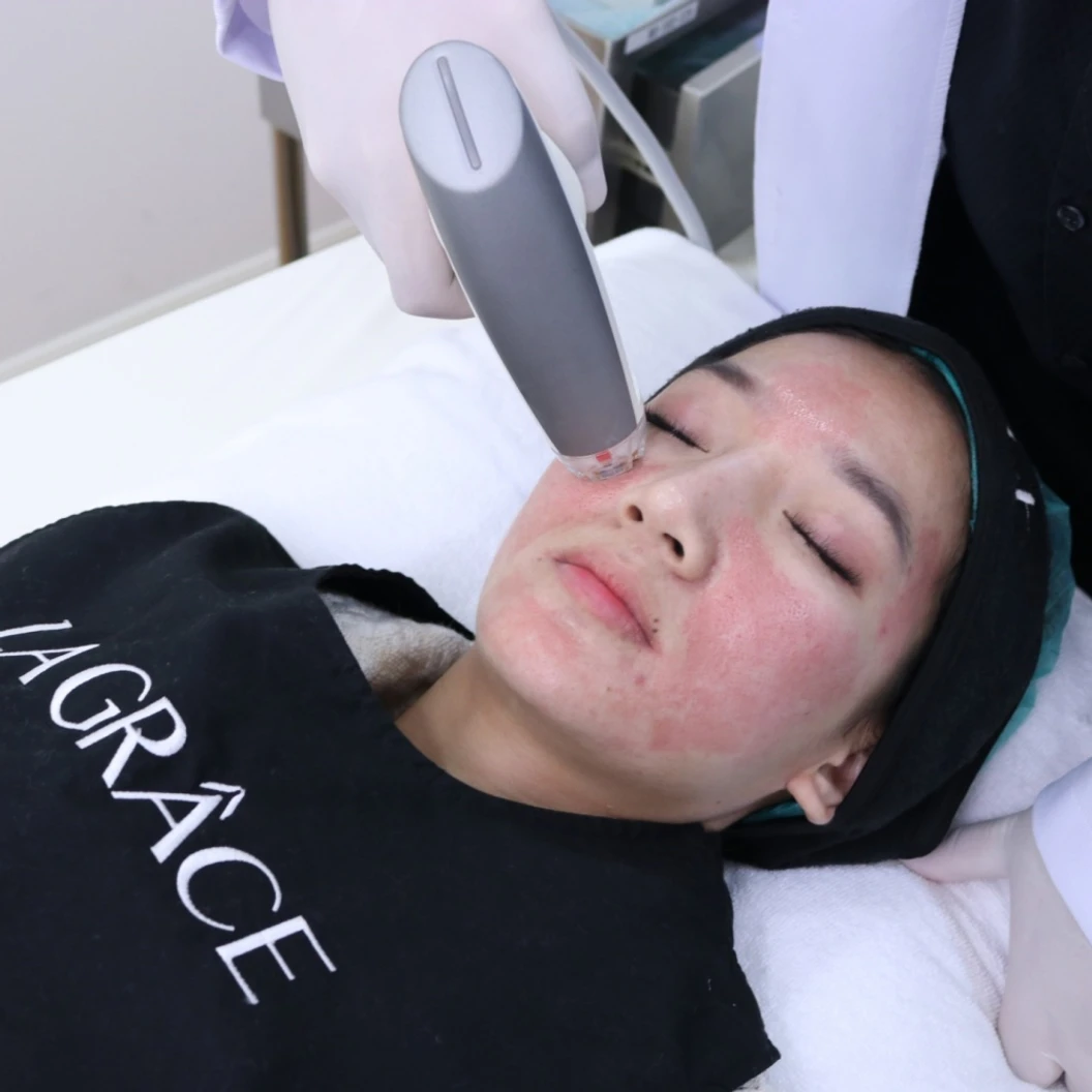 รักษาหลุมสิว ด้วยเทคโนโลยี Fractional RF ใช้หัวทิปทองคำ (Miracle Deep Gold) 1 ครั้ง