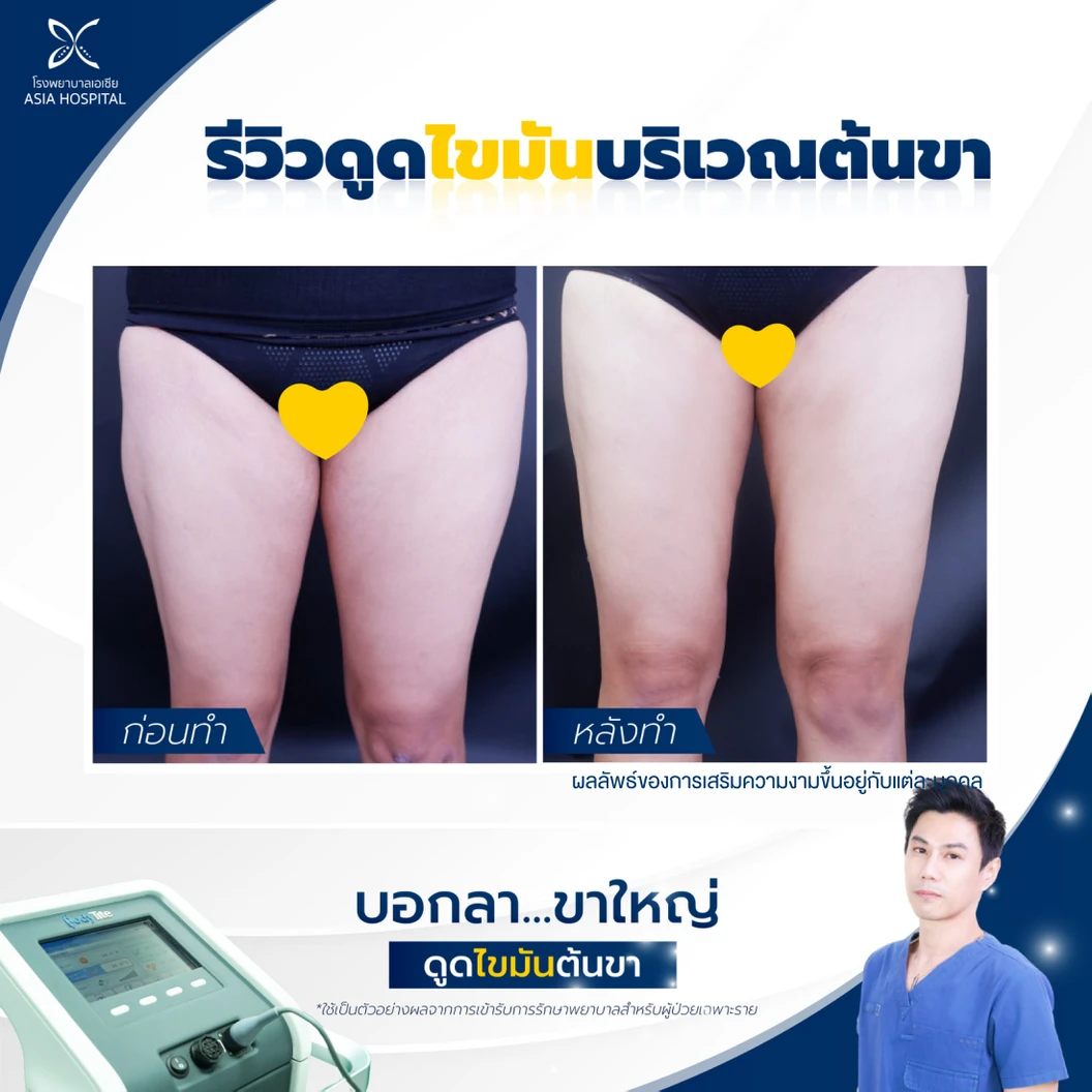โปรแกรมดูดไขมันด้วยเครื่อง BodyTite เหมาต้นขา 2 ข้าง 1 ครั้ง