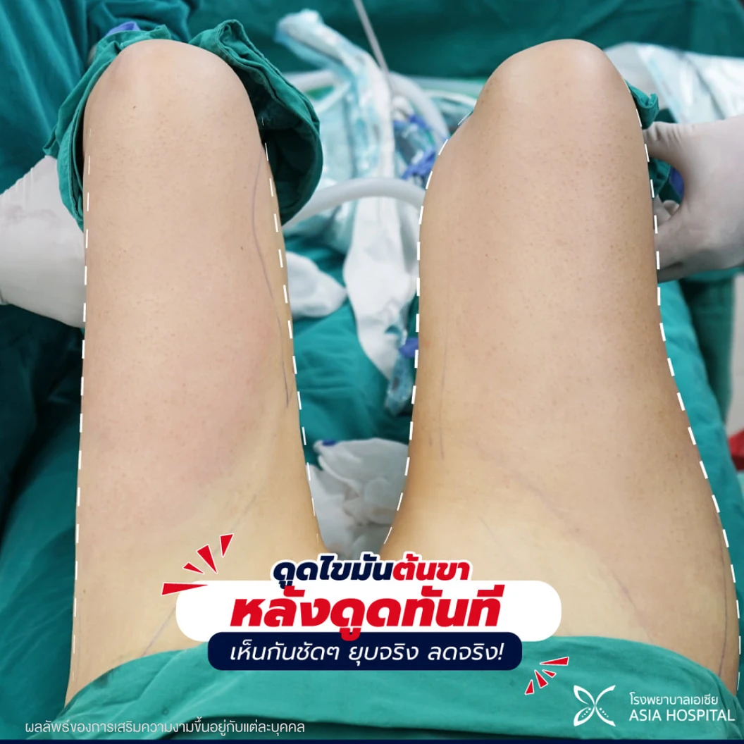 โปรแกรมดูดไขมันด้วยเครื่อง BodyTite เหมาต้นขา 2 ข้าง 1 ครั้ง