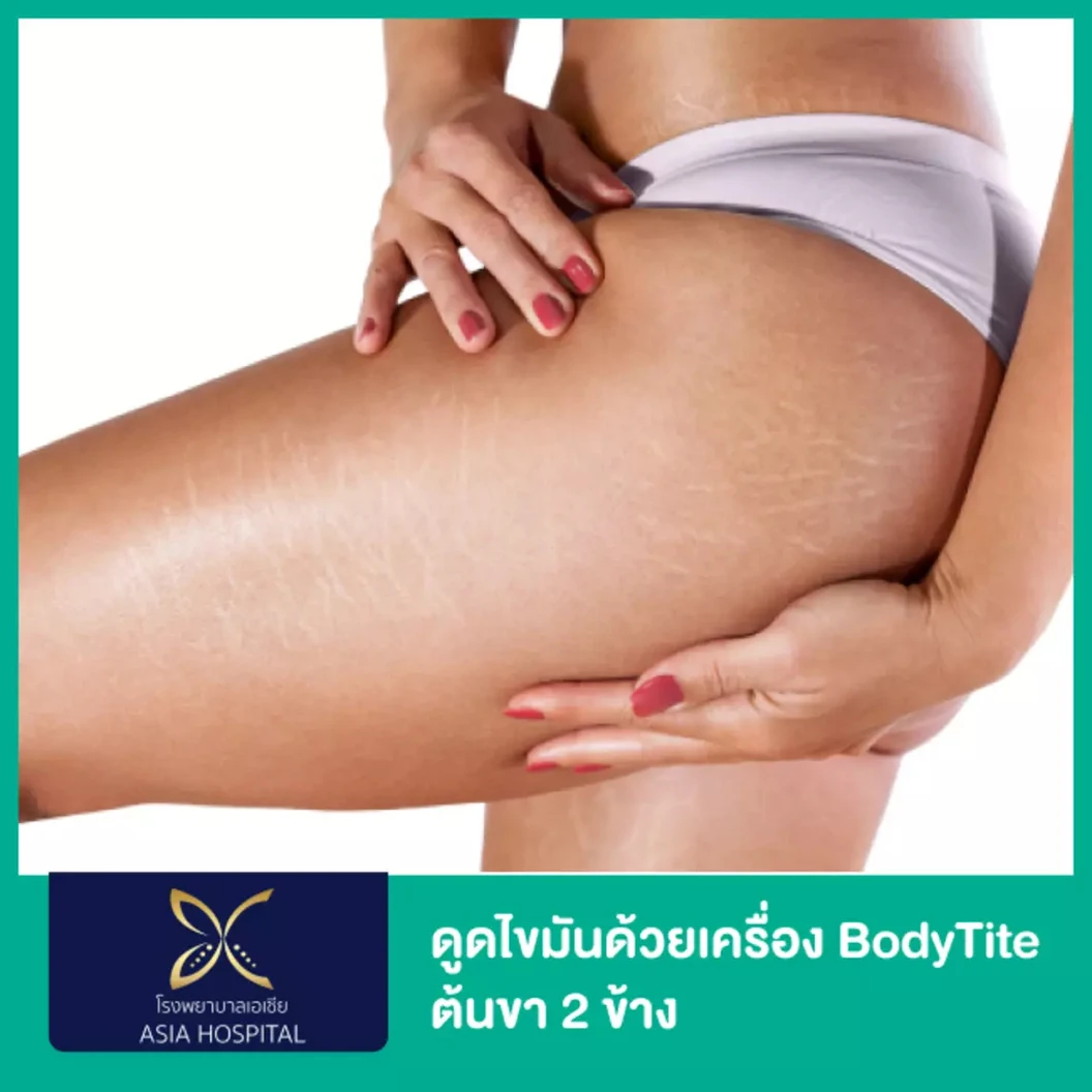 โปรแกรมดูดไขมันด้วยเครื่อง BodyTite เหมาต้นขา 2 ข้าง 1 ครั้ง