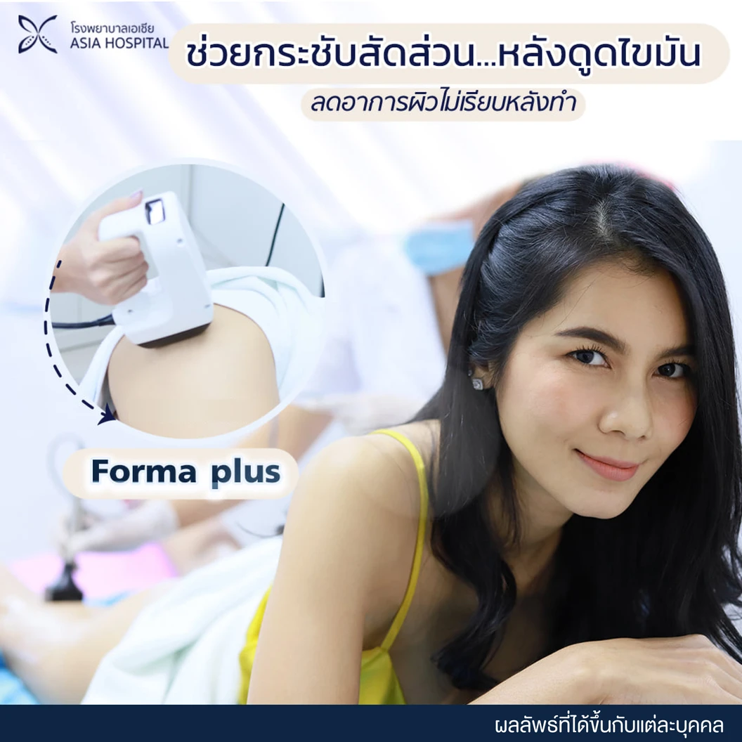 กระชับสัดส่วน บอกลาผิวเปลือกส้ม ด้วยคลื่นความถี่วิทยุ RF เครื่อง FormaPlus 1 ครั้ง